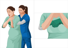 <p>Chest thrusts instead of abdominal thrusts</p>