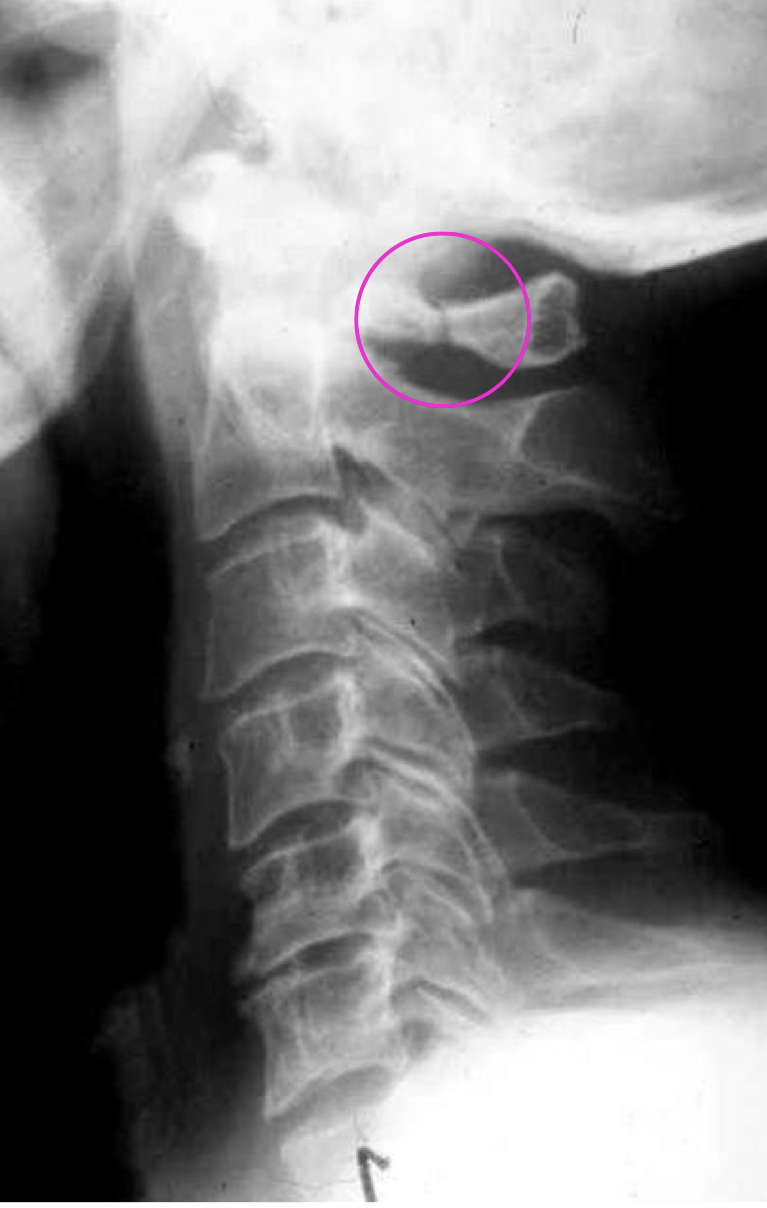 <p>Posterior Arch Fracture characteristics</p>