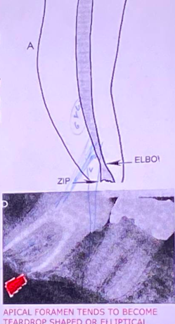 <p><span>﻿﻿Refers to transportation of the apical portion of the canal </span></p><p><span>﻿﻿It is characterized by a normally curved canal which has been straightened, especially in the apical third</span></p>