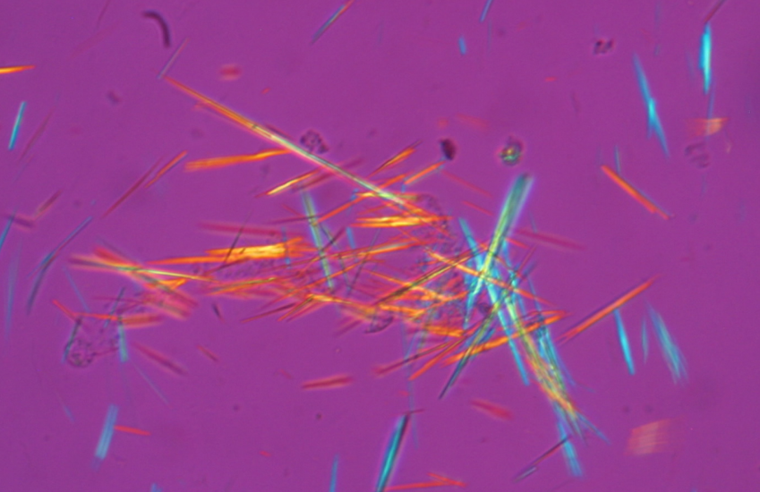 <p>negatively birefringent, needle-shaped crystals</p>