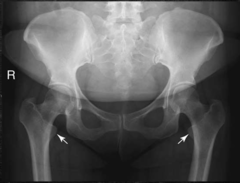 <p>How is the femur rotated?</p>