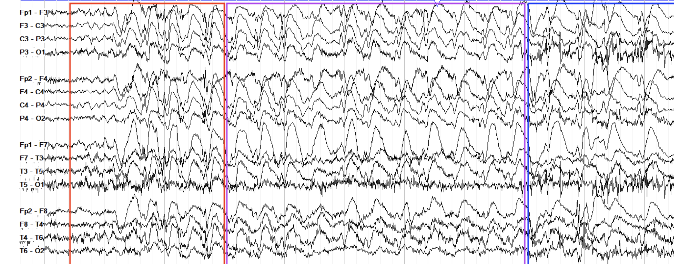 <p>theta spam everywhere synchronized. 3hz→2hz→1.5Hz→0</p>