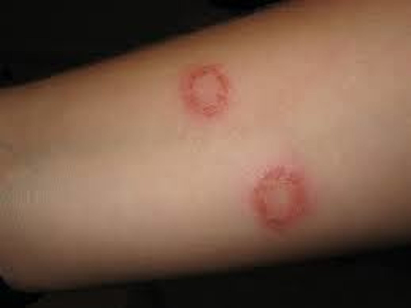 <p>A fungal infectious disease that affects cattle.</p><p>- Causes growth of fungus under skin, leading to rash</p><p>- Diagnosed through observation</p><p>- Treated with antifungal cream</p>
