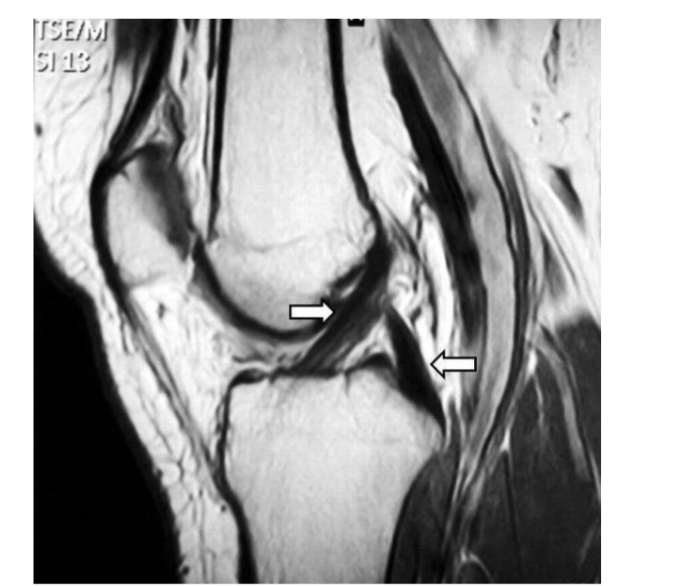 <p>Primary:</p><ul><li><p>resist posterior shear of tibia (b/c Insertion is further from origin) </p></li></ul><p></p><p>Secondary:</p><ul><li><p>resist ER of tibia </p></li></ul><p></p><p>Impact of Hamstring contraction</p><p></p>