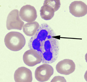 <p>Women have a Barr body (Drumstick), due to a condensed X chromosome</p>