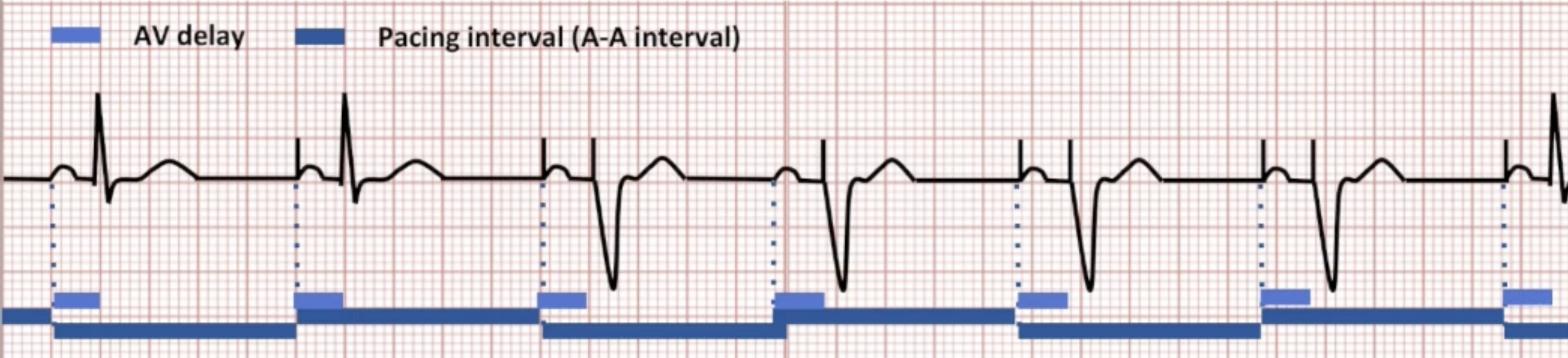 <ul><li><p>Atrial pacing driven by A-A interval</p></li><li><p>Device adjusts other intervals to keep A-A interval constant</p></li><li><p>VA interval can be calculated, but is not used</p></li></ul><p></p>