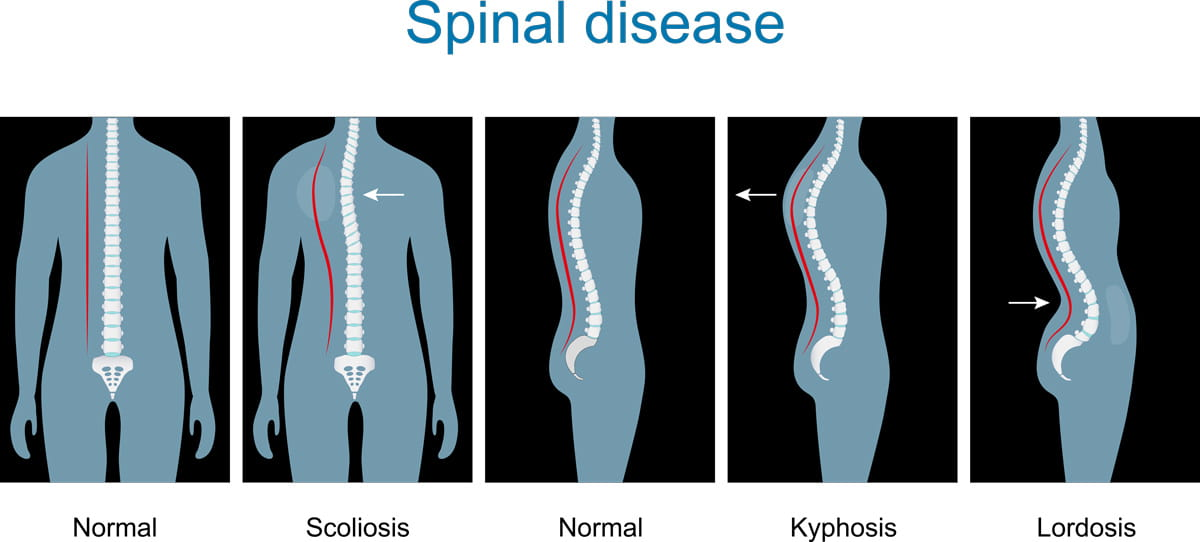 <p>Gibbus is thoracolumbar kyphosis (at the thoracic and lumbar regions), resulting in a hunchback appearance. </p>