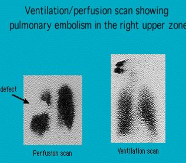 <p><strong>nuclear medicine</strong> screen testing for detection of perfusion defects of the lungs </p><ul><li><p>looks for <strong>pulmonary embolism </strong></p></li></ul><p></p>