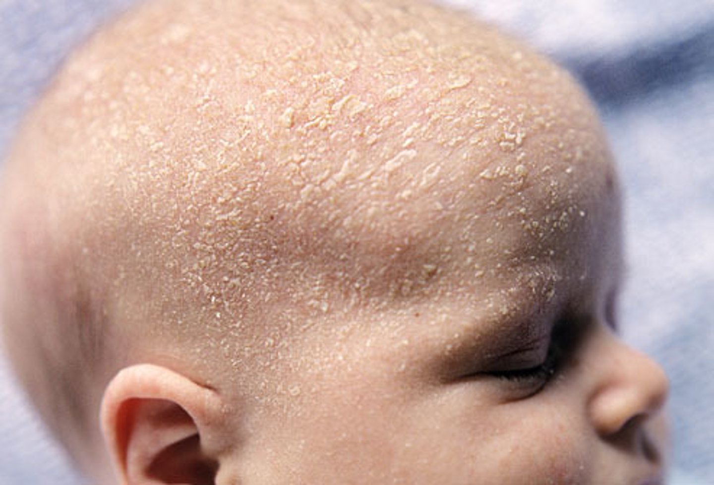 <p>severe oiliness of the scalp; results in scaly skin</p>