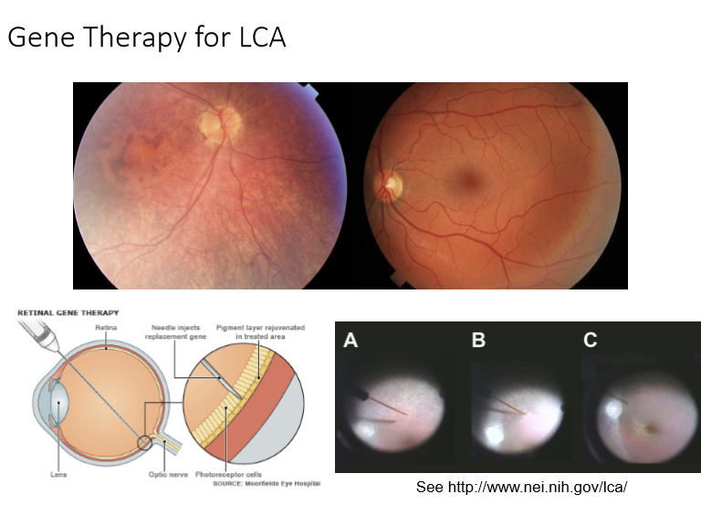 <p>• Gene therapy: AAV vector carrying functional RPE65<br>• Delivered via subretinal injection<br>• Restores the visual cycle → improves functional vision in eligible patients</p>