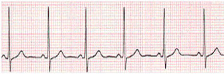 <p>what does this EKG show? </p>