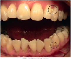 <p>Triangular-shaped spaces between teeth formed by bone on one side and the proximal surfaces and their contact area on the other side.</p>