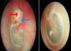 <p>Clytostoma → BAD</p><p>may lead to mastoidectomy</p>