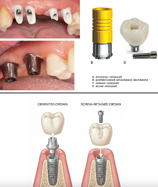 <p><span>the abutment is the portion of the implant that supports or retains a prosthesis or implant superstructure.</span></p><p><span style="color: rgb(255, 0, 0);">• three main categories:<br></span><span>(1) screw retained<br>(2) cement retained<br>(3) prefabricated attachment abutments</span></p>