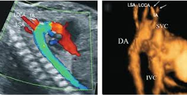 <p>right arm BP > LT arm </p>