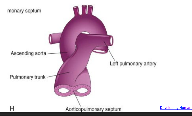 <p>Great arteries (ascending aorta and pulmonary trunk) twisting around each other as they leave the heart</p><p>In the RVOT view the PA will be elongated and the AO will be transverse and that tells us a true criss croos is happening</p>