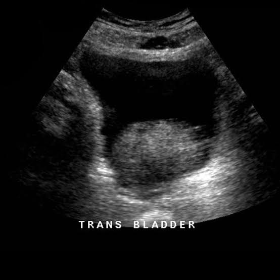 <p>hyperplastic nodules form around the urethra and may obstruct the flow of urine </p><ul><li><p>causes urinary retention</p></li><li><p>central gland enlarged, hypoechoic, mixed echogenicity, calc</p></li></ul><p></p>