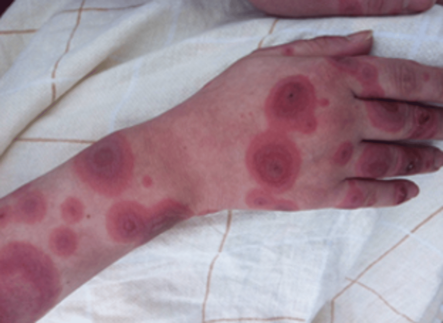 <p>having red coloration typically referring to increased blood flow, inflammation</p>