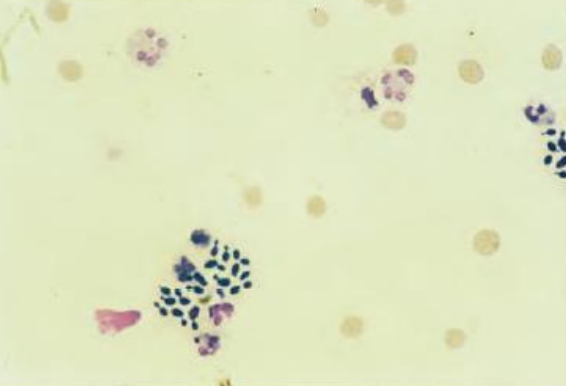 <p><strong><u>Ascitic Fluid Cells: Peritoneal Fluid</u></strong></p>