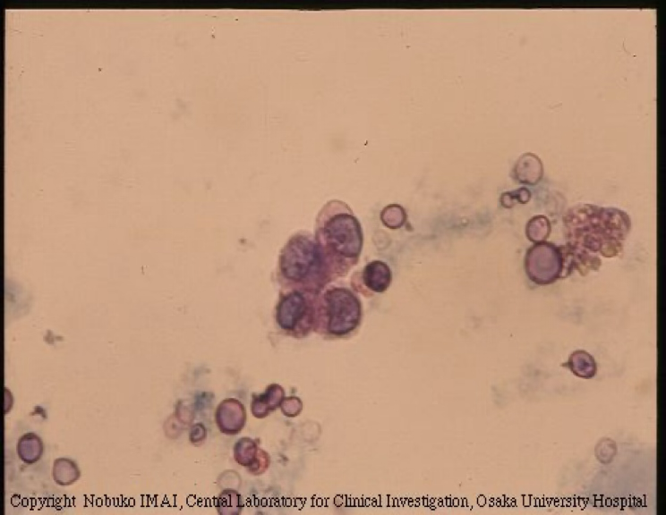 <ul><li><p><strong>The smallest epithelial cell observed in urine sediment.</strong></p></li><li><p>Rarely found, but am increased number seen can indicate renal tubular disease or degeneration/diseases of the kidney parenchyma.</p></li></ul><p></p>