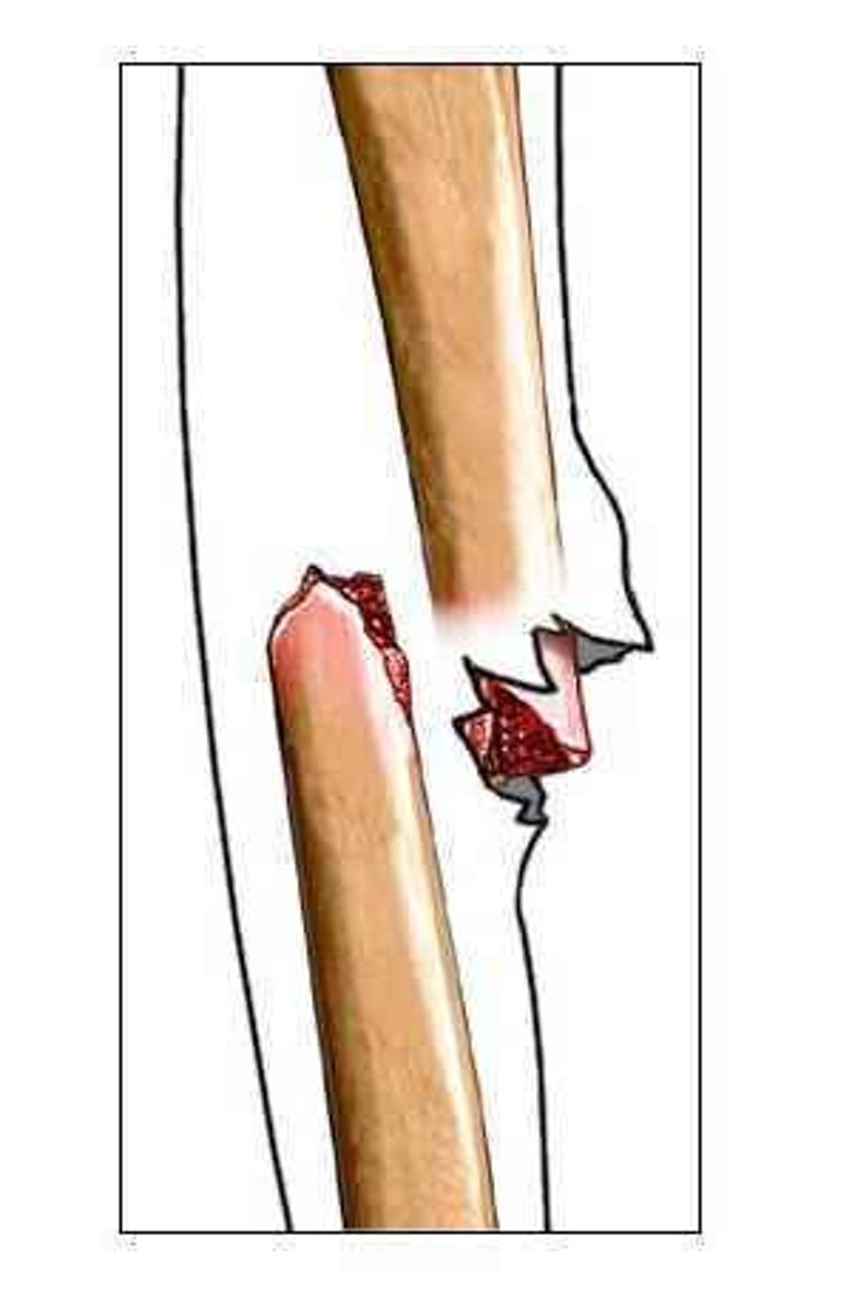<p>bone ends are out of normal alignment</p>