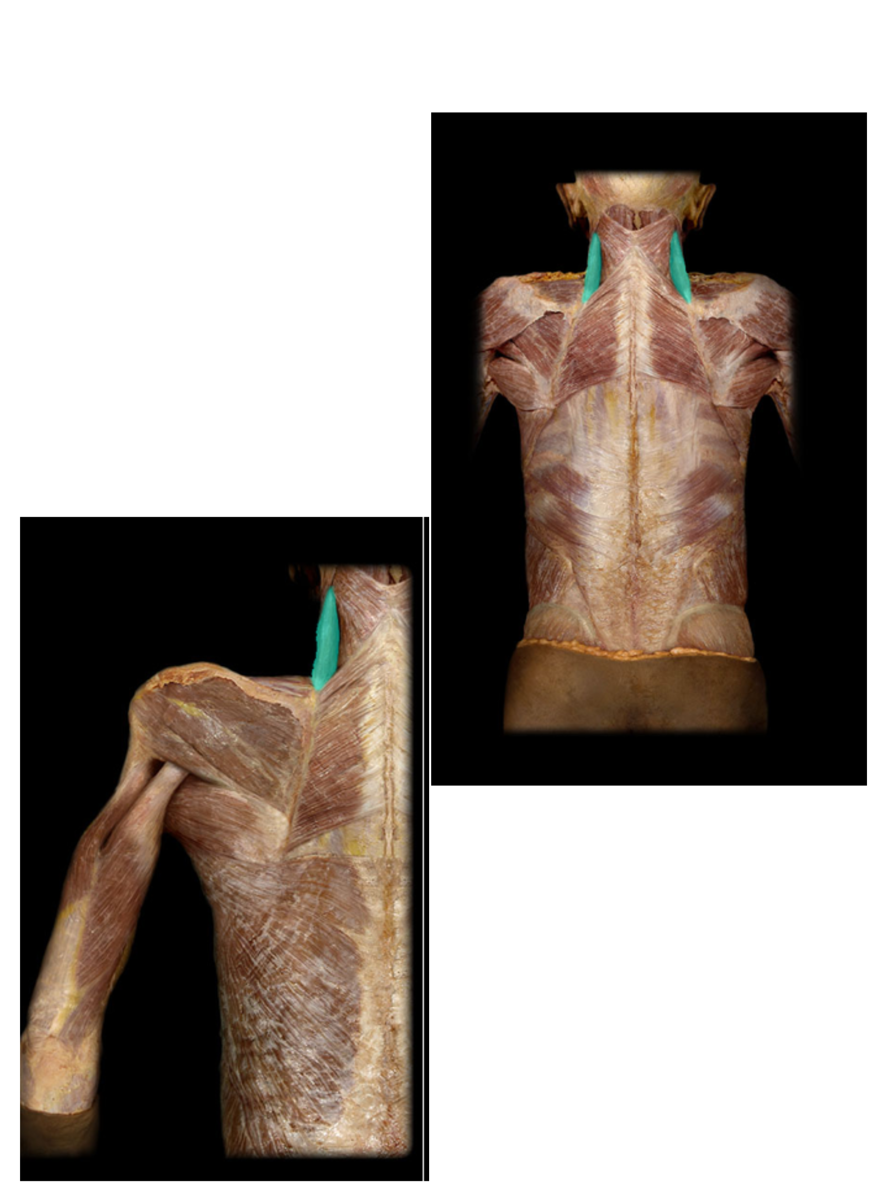 <p>Levator scapulae m.</p>