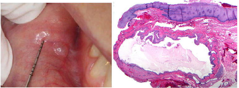 <p>salivary duct cyst</p>