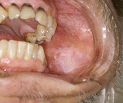 <p>What is this lesion?</p>