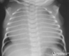 <p>CXR shows a very, very large heart and decreased pulmonary vascular markings</p>
