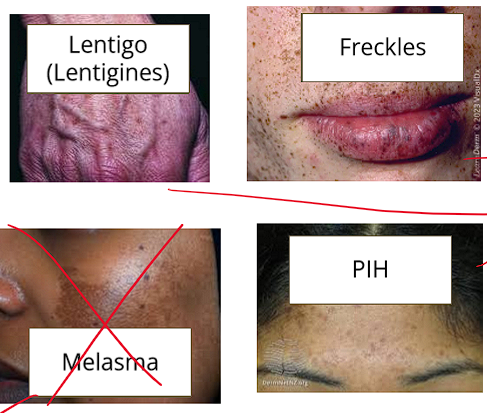 <ul><li><p>Freckle</p></li><li><p> lentigo</p></li><li><p>post inflammatory hyperpigmentation (PIH)</p></li><li><p>some nevi (moles)</p></li></ul><p></p>