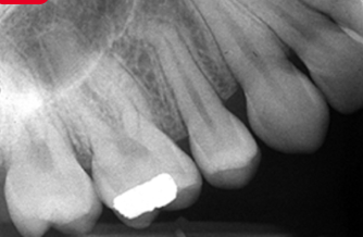 <p>Slanted Occlusal Plane </p><p><strong>What it looks like:</strong><br>Teeth appear <strong>tilted</strong>.</p>