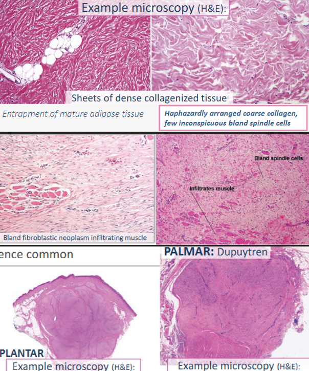 <ul><li><p>fibroma/fibromatosis (bland fibroblasts + dense collagen)</p><ul><li><p>gardner → plaque-like sheets w/ few spindle cell (<strong>APC mut./FAP)</strong></p></li><li><p>superficial → nodular proliferation (dupuytren, ledderhose)</p></li><li><p>desmoid (abdominal wall mass, post preg) → infiltrative, local/don’t metastasize, <strong>CTNNB1 (B-catenin)</strong></p></li></ul></li><li><p>fibrosarcoma → spindle cell w/<strong><u> herringbone</u></strong></p></li></ul><p></p>