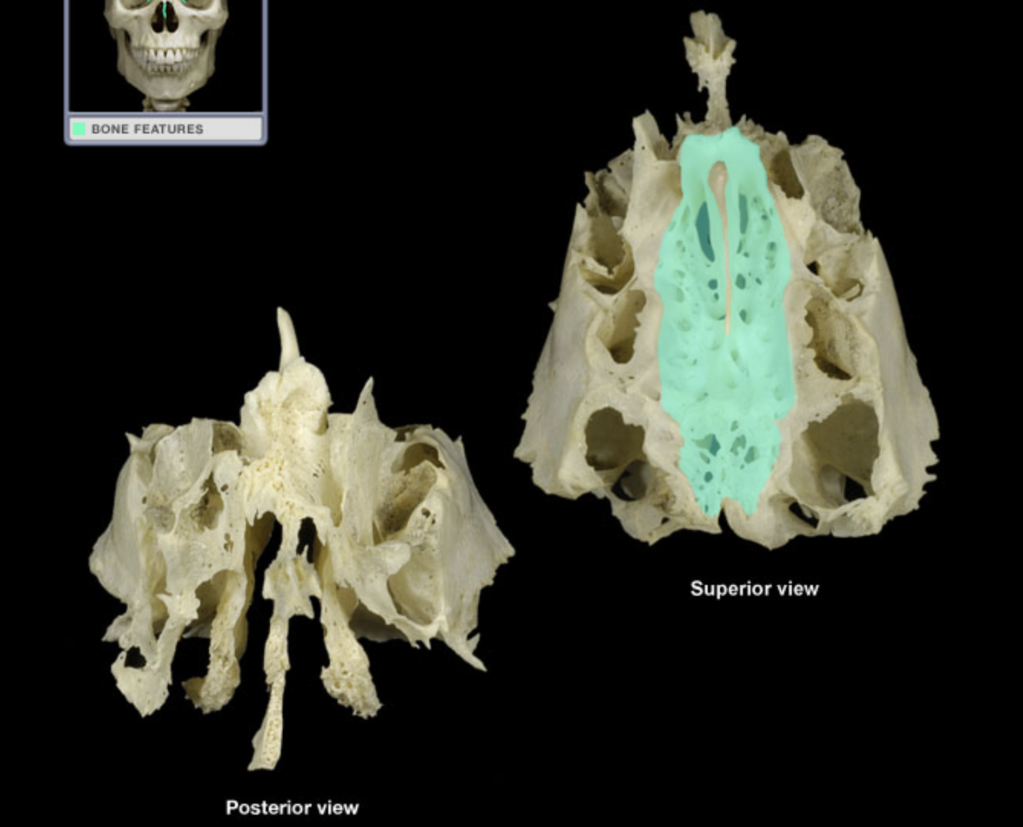 <p>*Holes in bone</p>