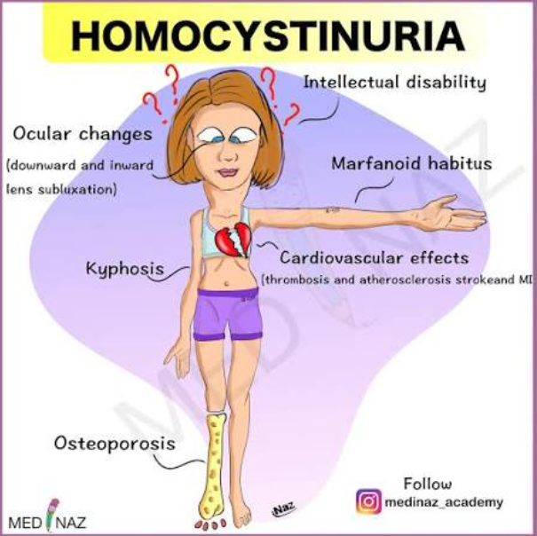 <p>cystathionine beta synthase deficiency <br>Presentation similar to Marfan syndrome with pectus deformity, tall stature, increase arm:height ratio, decrease upper:lower body segment ratio, arachnodactyly, joint hyperlaxity, skin hyperelasticity, scoliosis, fair complexion (vs Marfan syndrome), intellectual disability and development delay.</p><p>pulmonary embolism + DVT → early atherosclerosis<br>treatment: avoid methionine, increase cysteine, B6 supplementation</p>