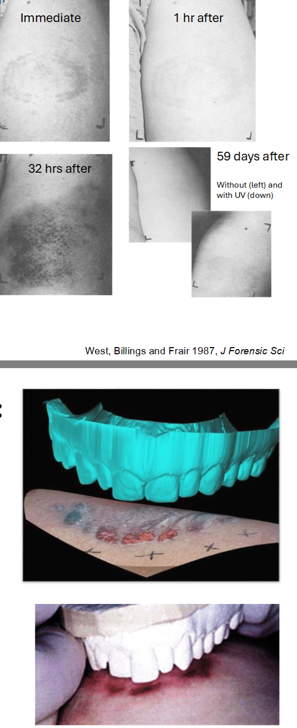 <ul><li><p>Typically performed by forensic odontologists (forensic dentists) beginning in the 70s/80s</p></li><li><p>From the victim, the following data are collected:</p></li></ul><p>1. Demographics (age, sex, ethnicity)</p><p>2. Location of bite mark and surface contour</p><p>3. Bite mark shape (e.g., round, ovoid)</p><p>4. Color and size of markings</p><ul><li><p>Photos taken with and without flash and UV over 24 hr intervals due to visibility differences</p></li></ul><p></p><p>Base layer of human skin contains melanin. Injury to the skin causes melanin to be released throughout the area. As it heals, cells (melaninocytes) migrate to edges of the wound.</p><p>Melanin <strong>absorbs </strong>UV radiation (think how different complexions tan differently) hence UV photography can capture these marks</p><p></p><ul><li><p>First 12 hours: high contrast and visibility</p></li><li><p>Day 2: No bite marks discerned, only bruising, which persisted for 12 days. UV could not discern bite</p></li><li><p>Day 17: Bitemark pattern reappeared in UV photographs</p></li><li><p>Day 60: Bitemark pattern peaked in visibility</p></li><li><p>Day 61+: Visibility decreased</p></li></ul><p></p><ul><li><p>Dental impressions and saliva sample from a suspect are taken</p></li><li><p>Look for any trace amounts of DNA in bite wound</p></li><li><p>Look for idiosyncrasies of dentition, such as:</p><ul><li><p>Canine-canine distance</p></li><li><p>Tooth alignment</p></li><li><p>Arch shape</p></li><li><p>Diastemas (gaps)</p></li><li><p>Dentistry work</p></li><li><p>Wear or chipping</p></li></ul></li></ul><p></p>