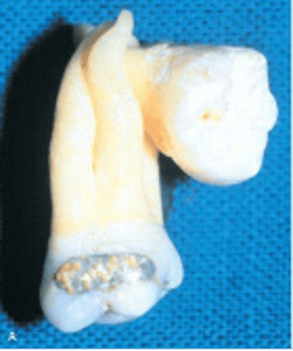 <p>Union of teeth by cementum</p><p><span>What is it called when two or more teeth are joined by cementum?</span></p>