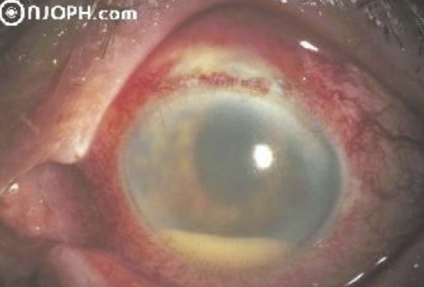 <p>Un homme de 78 ans se présente 4 jours après une chirurgie de cataracte pour douleur et rougeur de l'oeil opéré. Sa vision est à MM (<em>Mouvements de la main</em>). Son oeil ressemble à cette image. Quel est le diagnostic ?</p><p></p><p>A. Érosion de cornée</p><p>B. Crise de glaucome aigu</p><p>C. Conjonctivite</p><p>D. Endophtalmie</p>
