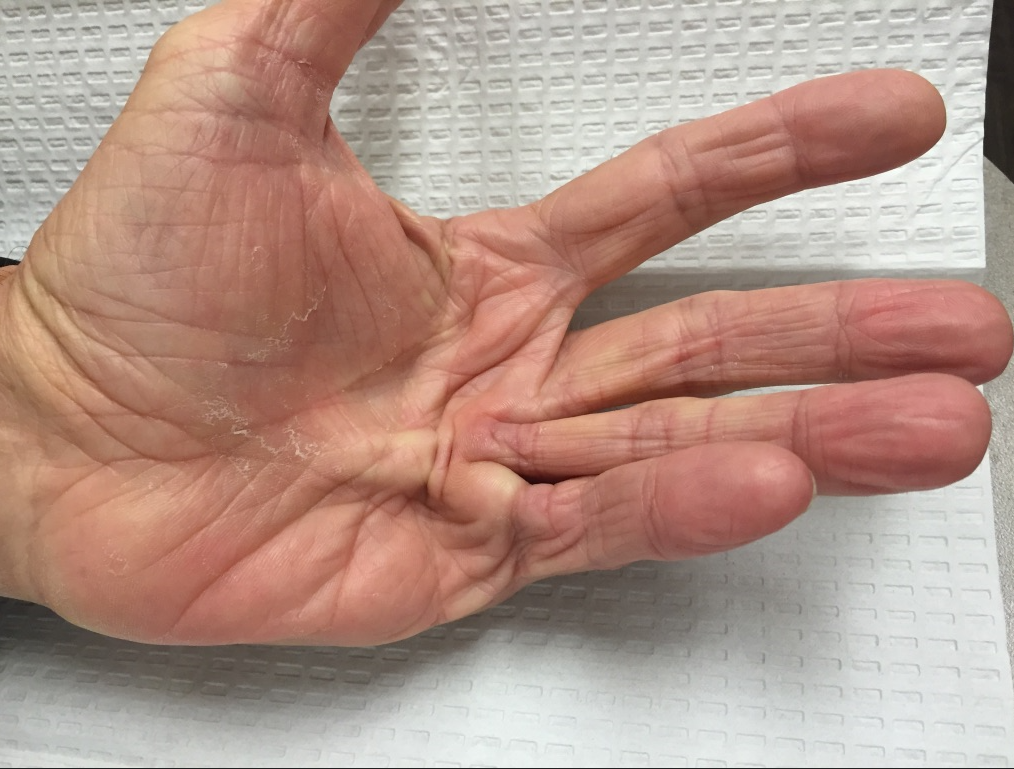 <p>What injury / condition? </p>