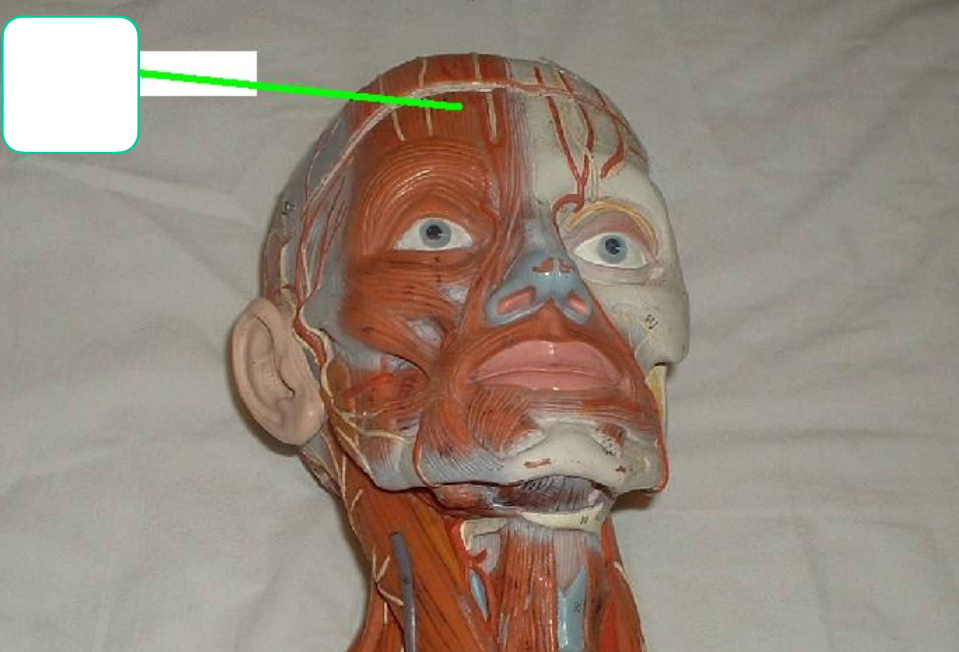 <p>right over frontal bone </p>
