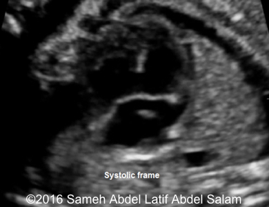 <p>Absence of the atrial and ventricular septum</p><p>Color Doppler findings are helpful at showing mixture of flow patterns</p>