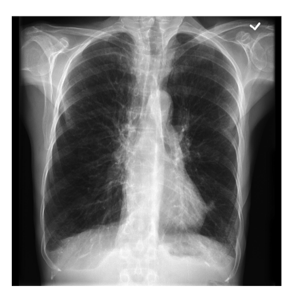 <p>what is pictured/what is occurring with the lungs in the image attached? </p>