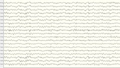 <p>It has high temporal resolution, allowing detection of millisecond changes in neural activity.</p>