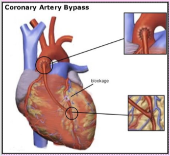 <p>a surgery that bypasses/detours a major block in a heart blood vessel by taking another blood vessel from another part of the body</p>