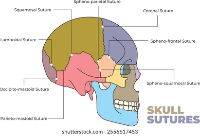 <p>coronal, sphenosquamosal, sphenoparietal, squamous and sphenofrontal</p>