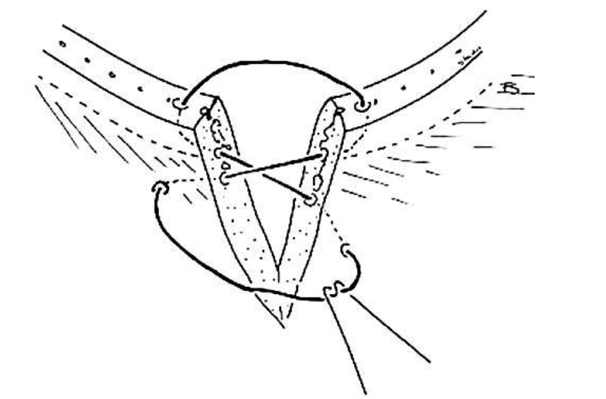 <p>Which type of trauma (sharp or blunt) will require surgical repair if affecting the eyelids? Lacerations must be repaired immediately with minimal debridement, two-layer closure if extensive, and alignment of the lid margin with a figure eight pattern.</p>