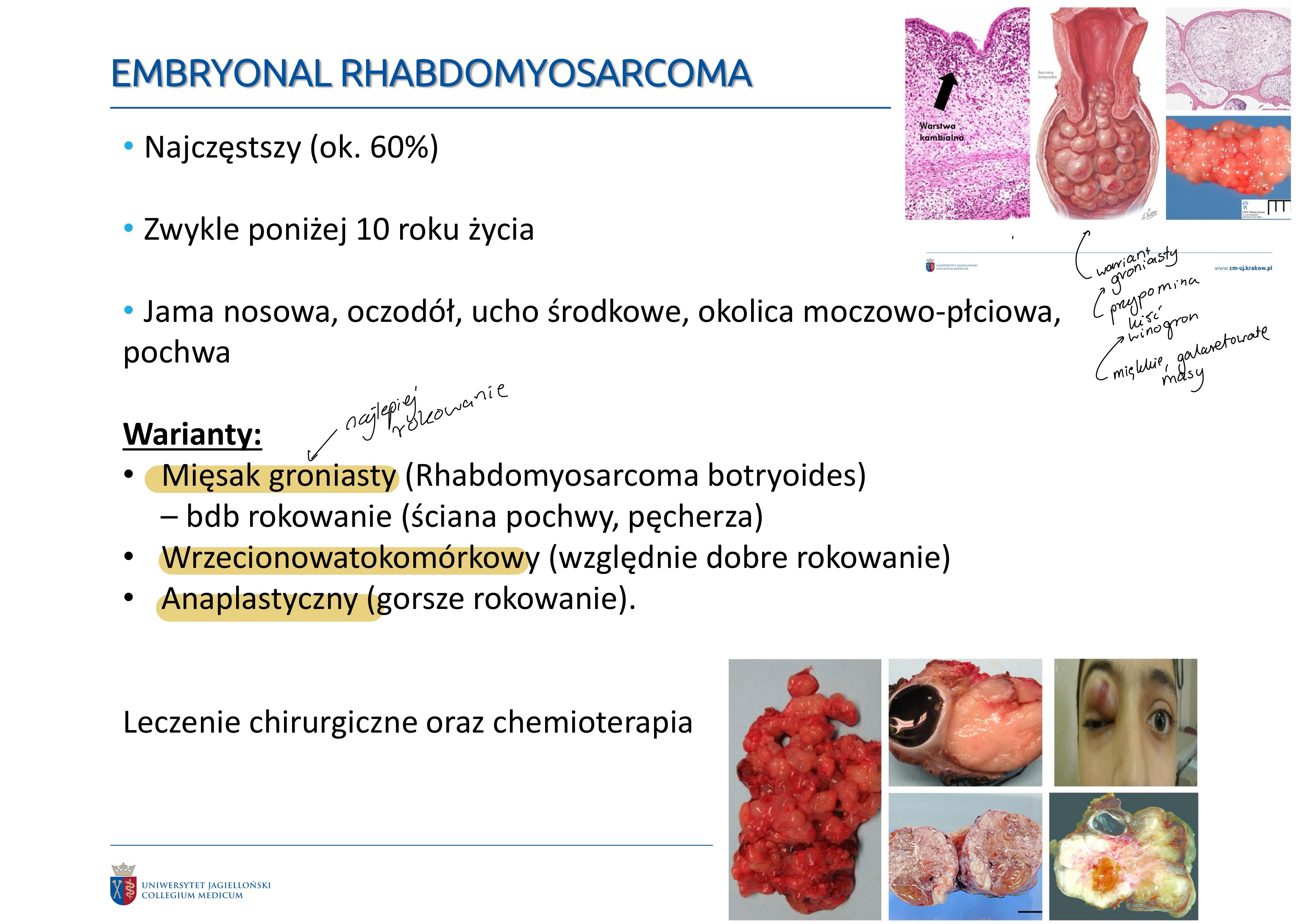 <p>MORFOLOGIA</p><ul><li><p>imituje obraz mięśnia szkieletowego w różnych stadiach jego rozoju zarodkowego</p></li><li><p>lite pola komórek okrągłych i wrzecionowatych</p></li><li><p>w częsci komórek poprzecne prążkowanie</p></li><li><p>mięsak groniasty:</p><ul><li><p>miękkie, galaretowate masy przypominające kiść winogron</p></li><li><p>bezpośrednio pod pow. błony śluzowej</p></li></ul></li></ul><p></p>