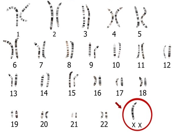 <ul><li><p>A numerical abnormality as they possess only one X chromosome (XO)</p></li><li><p><span>Genetically female as they possess an X chromosome</span></p></li><li><p><span>Sterile (undeveloped ovaries)</span></p></li><li><p><span>Symptoms include short stature, wide chest, webbing of neck and heart defects</span></p></li></ul><p></p>