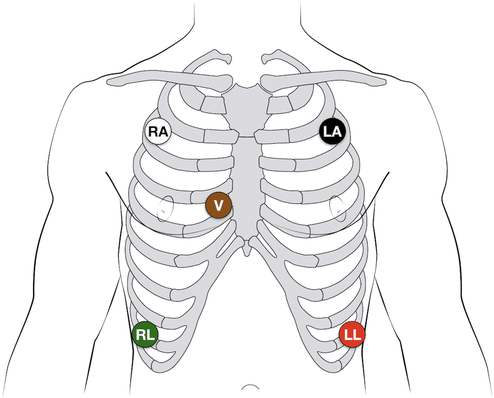 <p>where is the singular non-limb electrode placed for a 5-lead EKG</p>