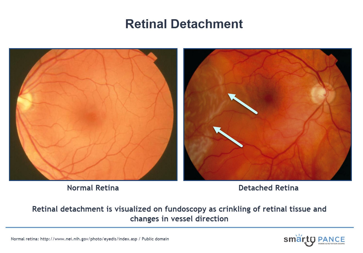 <p>Separation of the retina from the pigmented epithelial layer, causing the detached tissue to appear as a flap in the vitreous humor which can occur spontaneously or secondary to trauma / extreme myopia </p><p>-Presentation: vertical curtain coming down across the field of vision may sense floaters or flashes at the onset, loss of vision over several hours, myopia, peripheral visual field defects </p><p>-Dx: fundoscopy </p><p>-Tx: stay supine with head turned towards the side of the detached retina, pneumatic retinopexy </p>