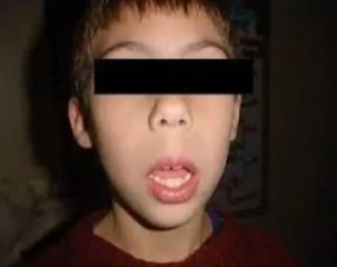 <p>¿Que tipo de facie presenta?</p>
